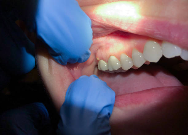 Best Emergency Wisdom Teeth Removal in Somonauk, IL