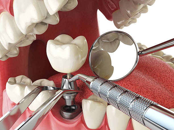Best Emergency Root Canal Treatment in Somonauk, IL